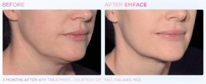 emface-before-and-after-photos-at-s-thetics-clinic-in-beaconsfield-buckinghamshire6