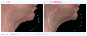 emface-before-and-after-photos-at-s-thetics-clinic-in-beaconsfield-buckinghamshire8