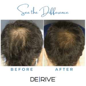 DE|RIVE before and after hair loss treatment S-Thetics Clinic in Beaconsfield2