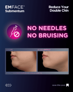 EMFACE-Submentum-double-chin-reduction-at-S-Thetics-Clinic-in-Beaconsfield-Buckinghamshire7