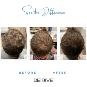 DE|RIVE before and after hair loss treatment S-Thetics Clinic in Beaconsfield